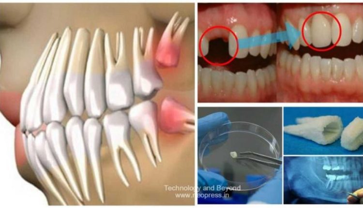 Mirupafshim implante dentare! Stomatologu rrit dhëmbë të rinj në vetëm 9 javë