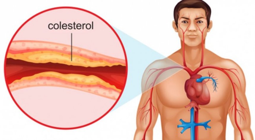 Kjo simptomë e kolesterolit të lartë vërehet rrallë, mos e neglizhoni..