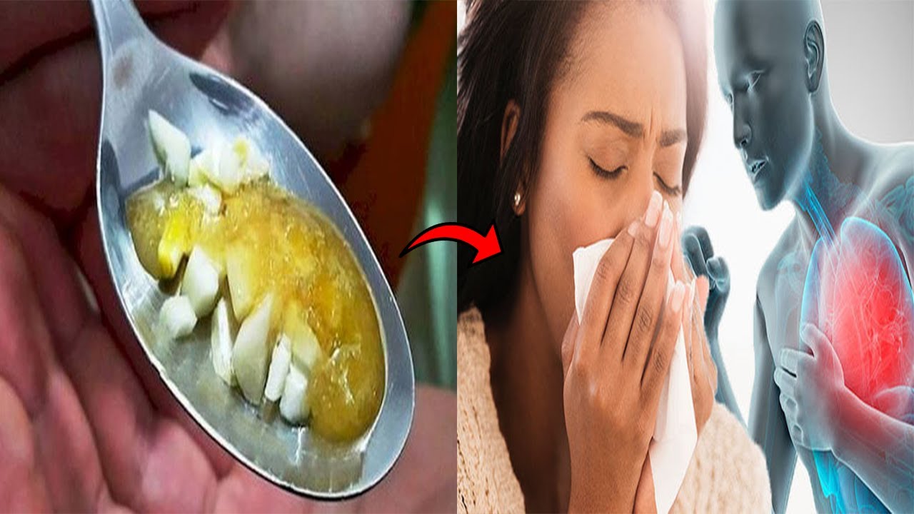 Gripi vazhdon të përhapet në Zvicër !