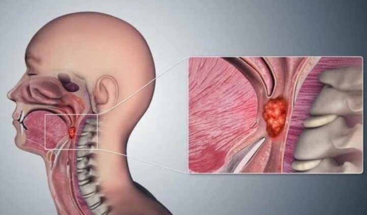 Kanceri i fytit po merr përmasat e epidemisë..!?