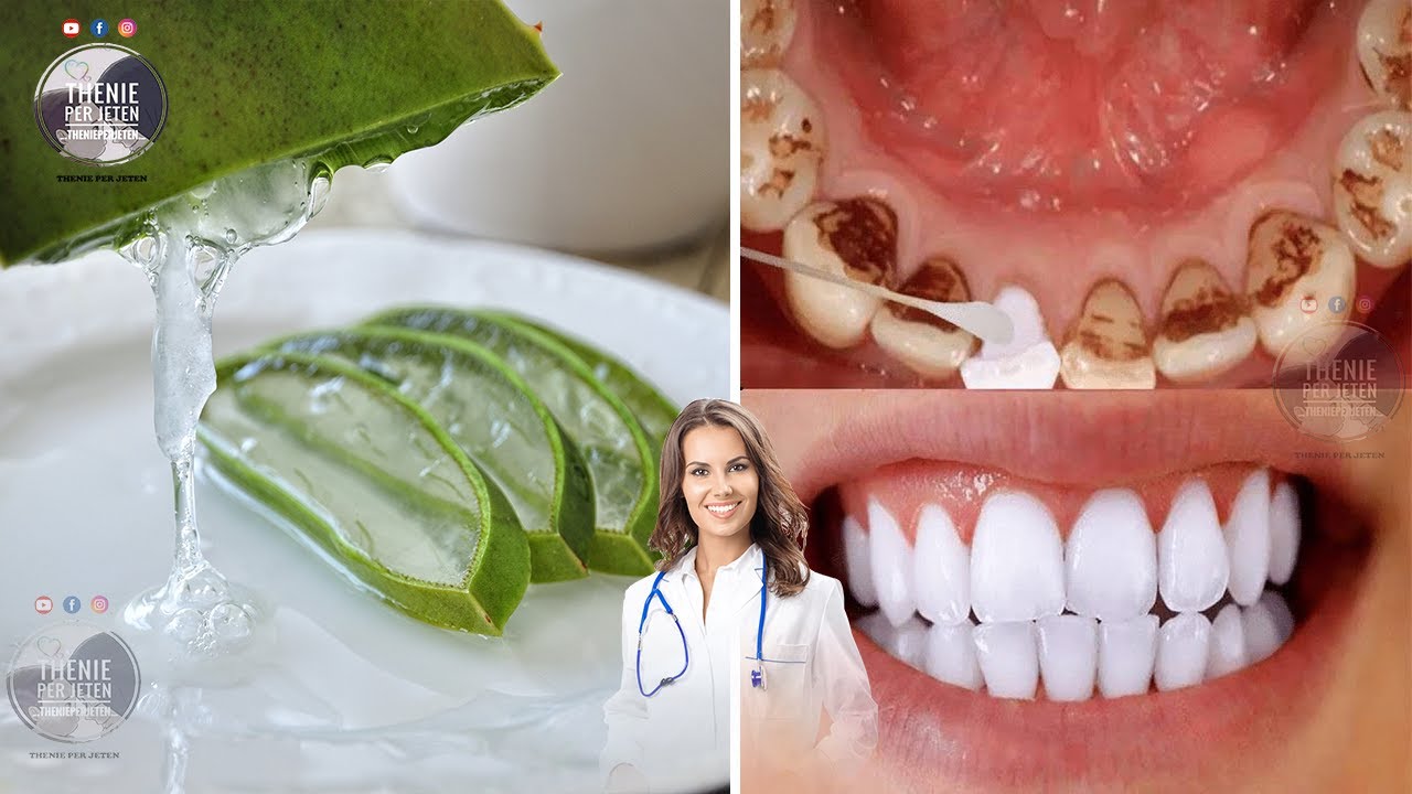 Si të përdorni aloe verën për shëndetin e dhëmbëve..!?