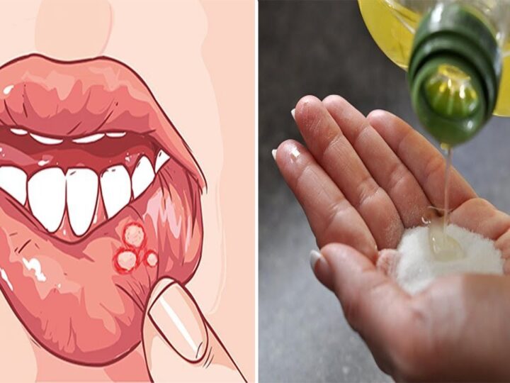 Herpes në buzë? Si të përshpejtoni shërimin e tyre..!