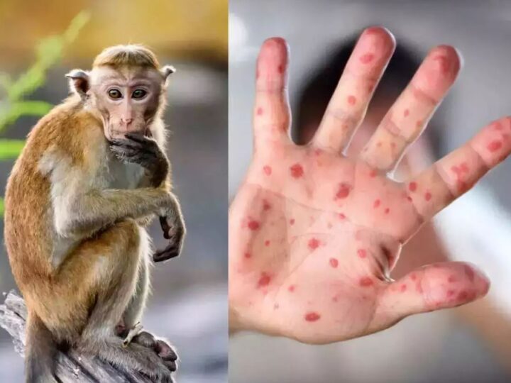 Në Shqipëri është identifikuar rasti i parë i lisë së majmunëve..!?