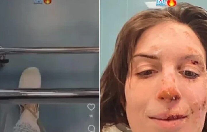 Rrëfimi i gruas që i mbijetoi zjarrit në Zvicër: Nuk e di si shpëtova ?