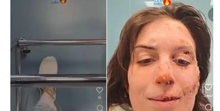 Rrëfimi i gruas që i mbijetoi zjarrit në Zvicër: Nuk e di si shpëtova ?