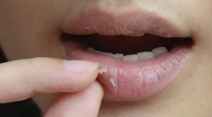 Çfarë të bëni kur ju plasariten buzët gjatë dimrit ?