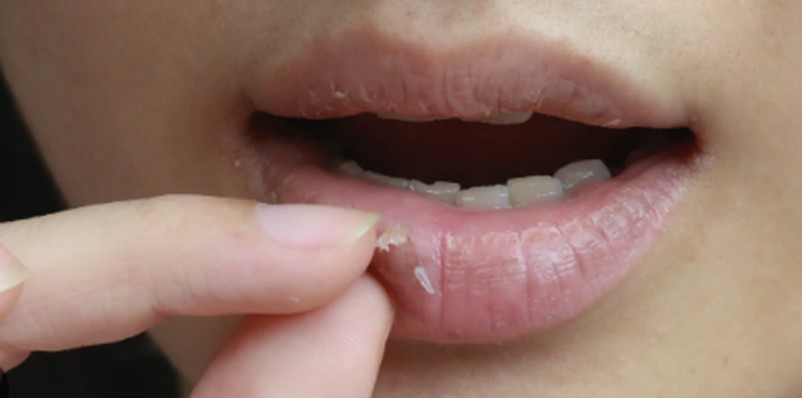 Çfarë të bëni kur ju plasariten buzët gjatë dimrit ?