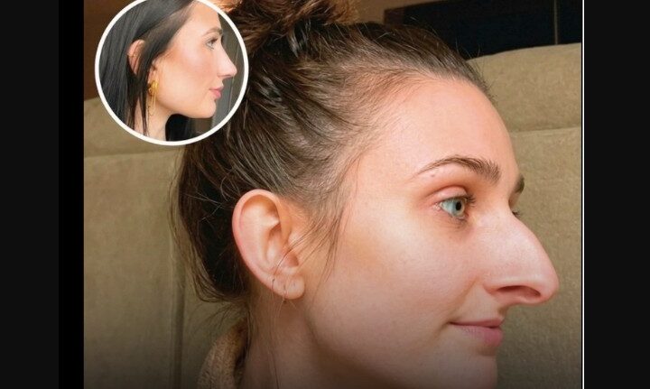 Ndodh dhe kjo! E bëri hundën operacion, pastaj u nda nga burri ?
