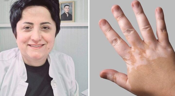 Zbulohet terapia për sëmundjen që konsiderohej e pashërueshme, do e prezanton Dr. Lulije Jahja nga Kërçova